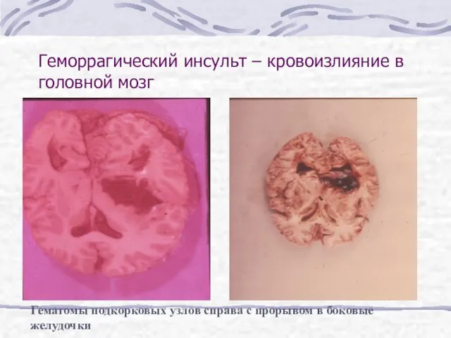 Геморрагический инсульт – кровоизлияние в головной мозг Гематомы подкорковых узлов справа с прорывом в боковые желудочки