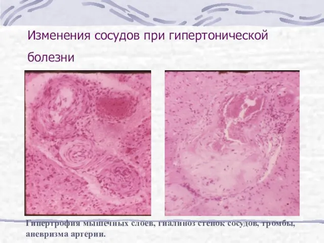 Изменения сосудов при гипертонической болезни Гипертрофия мышечных слоев, гиалиноз стенок сосудов, тромбы, аневризма артерии.