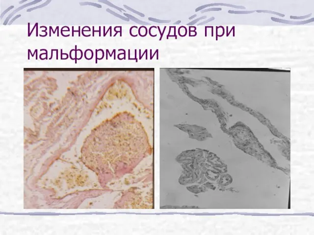 Изменения сосудов при мальформации