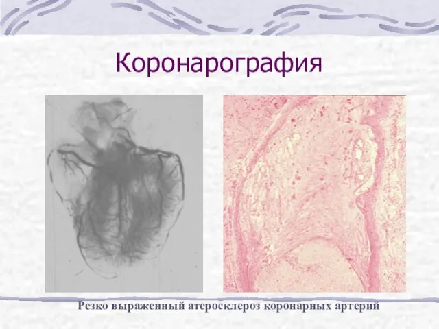 Коронарография Резко выраженный атеросклероз коронарных артерий