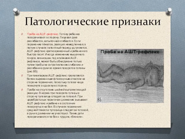 Патологические признаки Проба на АШТ-рефлекс. Голову ребенка поворачивают в сторону. Лицевая