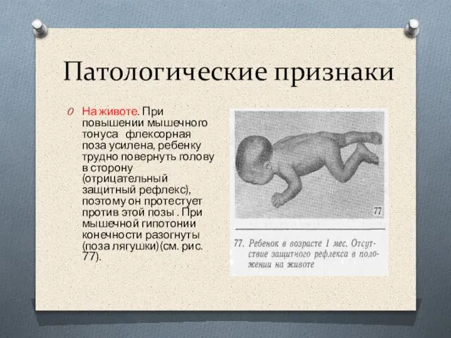 Патологические признаки На животе. При повышении мышечного тонуса флексорная поза усилена,