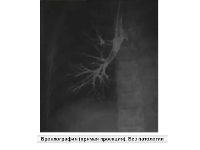 Бронхография (прямая проекция). Без патологии