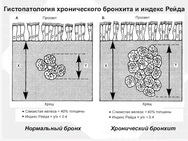 Гистопатология хронического бронхита и индекс Рейда Нормальный бронх Хронический бронхит