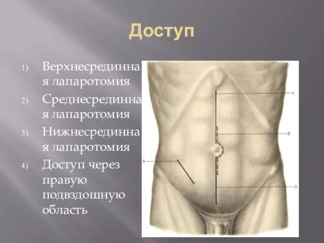 Доступ Верхнесрединная лапаротомия Среднесрединная лапаротомия Нижнесрединная лапаротомия Доступ через правую подвздошную область