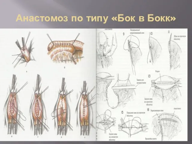 Анастомоз по типу «Бок в Бокк»