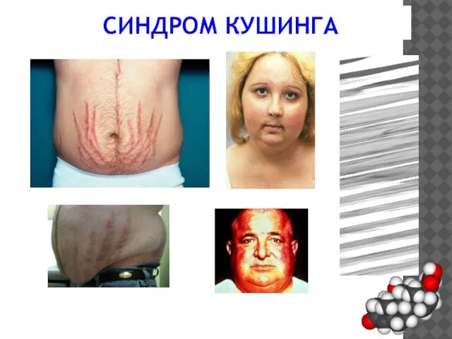 СИНДРОМ КУШИНГА