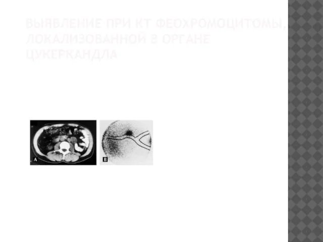 ВЫЯВЛЕНИЕ ПРИ КТ ФЕОХРОМОЦИТОМЫ, ЛОКАЛИЗОВАННОЙ В ОРГАНЕ ЦУКЕРКАНДЛА
