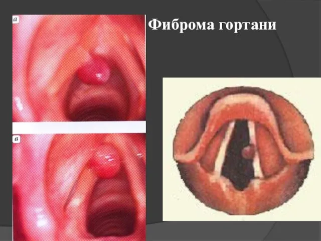 Фиброма гортани