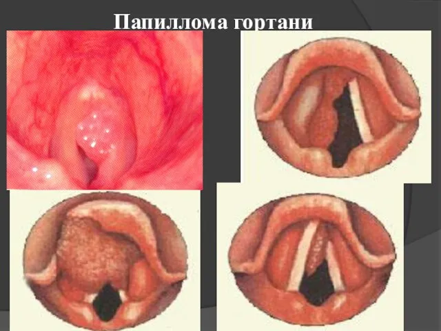 Папиллома гортани