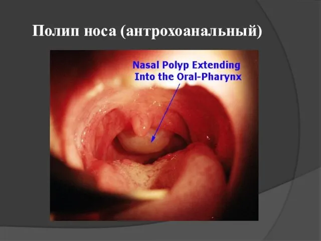 Полип носа (антрохоанальный)