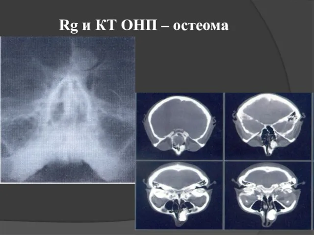 Rg и КТ ОНП – остеома