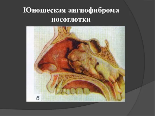 Юношеская ангиофиброма носоглотки