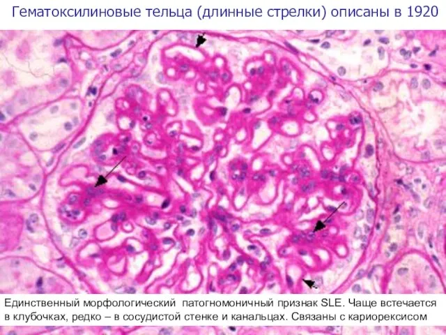 Гематоксилиновые тельца (длинные стрелки) описаны в 1920 Единственный морфологический патогномоничный признак