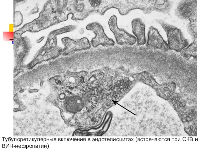 Тубулоретикулярные включения в эндотелиоцитах (встречаются при СКВ и ВИЧ-нефропатии).