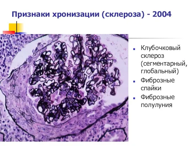 Признаки хронизации (склероза) - 2004 Клубочковый склероз (сегментарный, глобальный) Фиброзные спайки Фиброзные полулуния