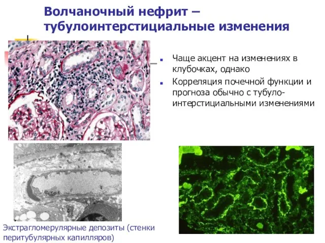 Волчаночный нефрит – тубулоинтерстициальные изменения Чаще акцент на изменениях в клубочках,