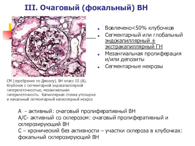 III. Очаговый (фокальный) ВН Вовлечено Сегментарный или глобальный эндокапиллярный ± экстракапиллярный