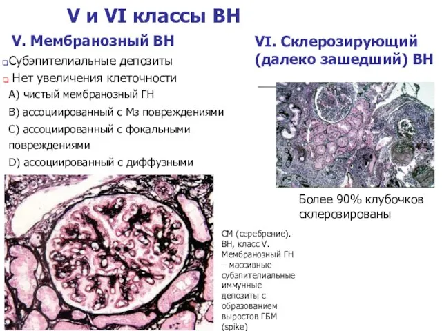 V и VI классы ВН V. Мембранозный ВН Субэпителиальные депозиты Нет