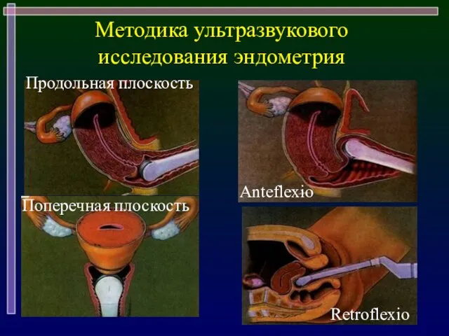 Методика ультразвукового исследования эндометрия Продольная плоскость Поперечная плоскость Anteflexio Retroflexio