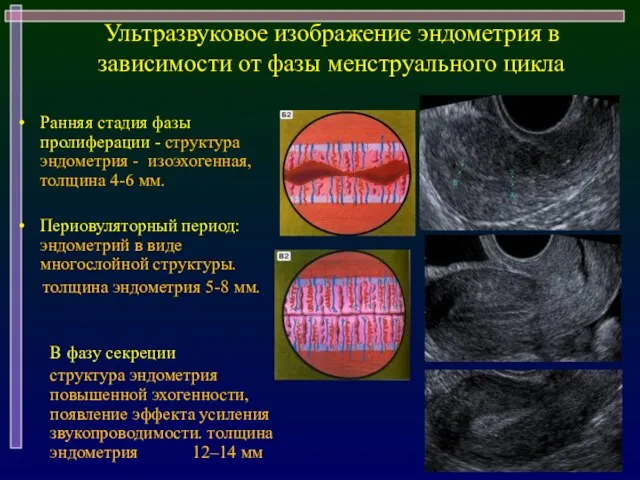 Ультразвуковое изображение эндометрия в зависимости от фазы менструального цикла Ранняя стадия