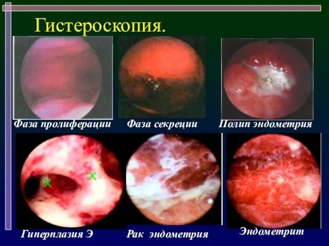 Гистероскопия. Эндометрит Гиперплазия Э Рак эндометрия Фаза пролиферации Фаза секреции Полип эндометрия