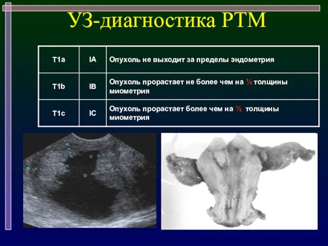 УЗ-диагностика РТМ