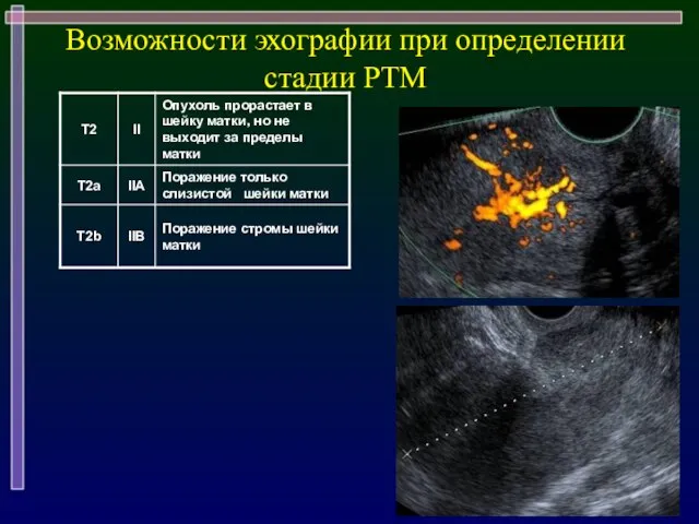 Возможности эхографии при определении стадии РТМ