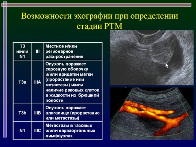 Возможности эхографии при определении стадии РТМ