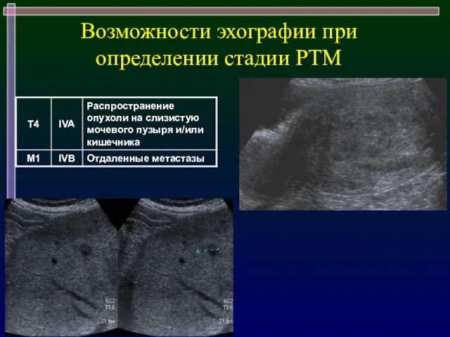 Возможности эхографии при определении стадии РТМ