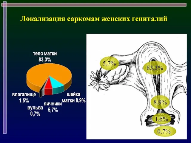 Локализация саркомам женских гениталий 83,3% 8,9% 5,7% 0,7% 1,5%