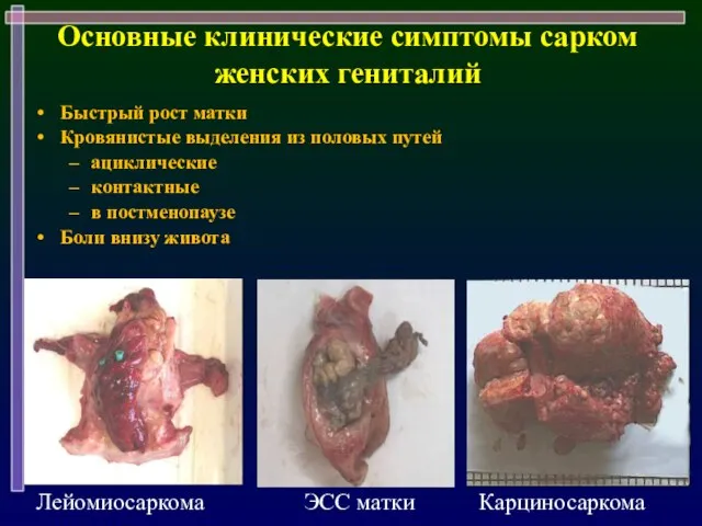 Основные клинические симптомы сарком женских гениталий Быстрый рост матки Кровянистые выделения