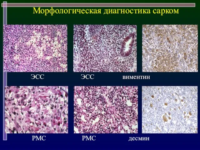 Морфологическая диагностика сарком ЭСС ЭСС виментин РМС РМС десмин