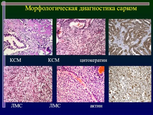 Морфологическая диагностика сарком КСМ КСМ цитокератин ЛМС ЛМС актин