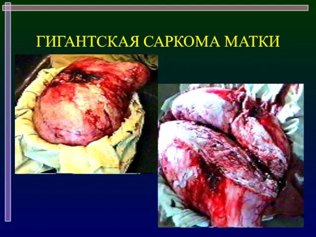 ГИГАНТСКАЯ САРКОМА МАТКИ