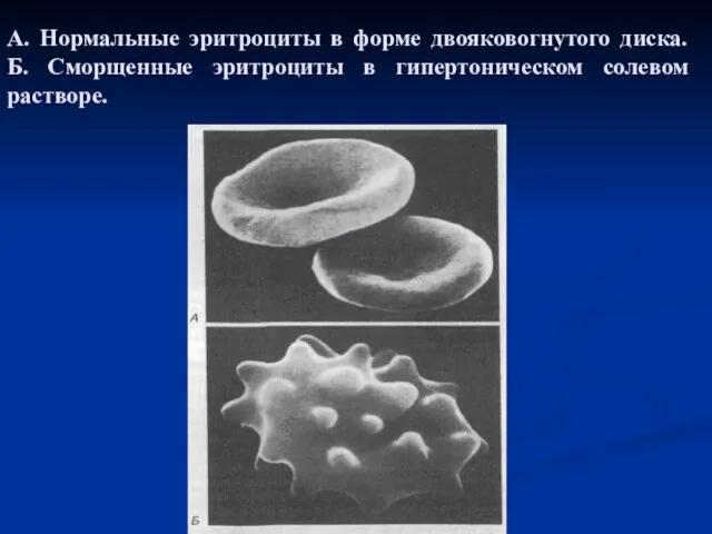 А. Нормальные эритроциты в форме двояковогнутого диска. Б. Сморщенные эритроциты в гипертоническом солевом растворе.