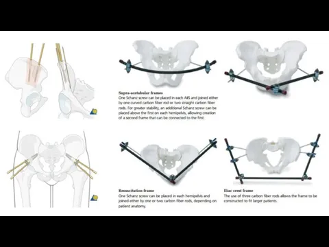 Pin insertion in the iliac crest Pin insertion in supra acetabular position