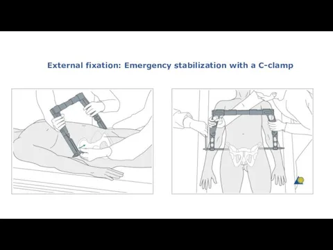 External fixation: Emergency stabilization with a C-clamp