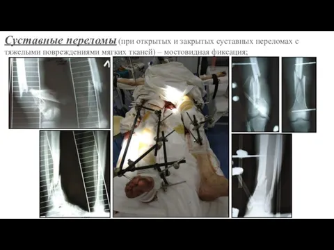 Суставные переломы (при открытых и закрытых суставных переломах с тяжелыми повреждениями мягких тканей) – мостовидная фиксация;
