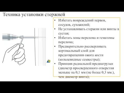 Техника установки стержней Избегать повреждений нервов, сосудов, сухожилий; Не устанавливать стержни