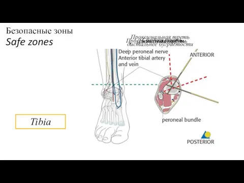 Безопасные зоны Safe zones Tibia Проксимальная треть Проксимальная треть дистальнее бугристости Средняя треть Дистальная треть