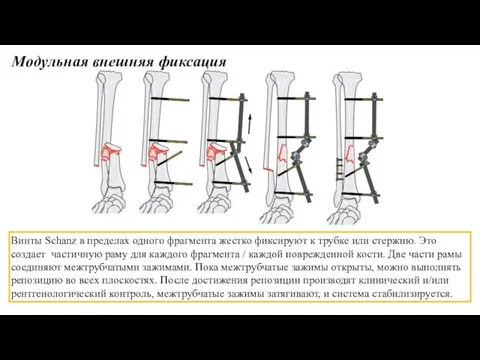 Винты Schanz в пределах одного фрагмента жестко фиксируют к трубке или