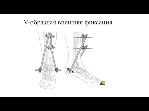 V-образная внешняя фиксация