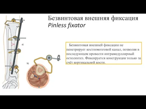 Безвинтовая внешняя фиксация Pinless fixator Безвинтовая внешней фиксации не пенетрирует костномозговой