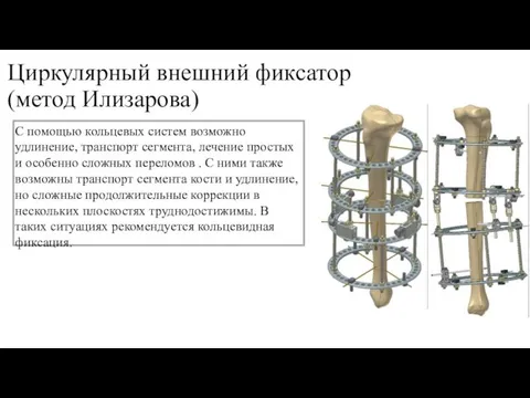 Циркулярный внешний фиксатор (метод Илизарова) С помощью кольцевых систем возможно удлинение,