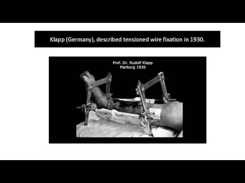 Klapp (Germany), described tensioned wire fixation in 1930.