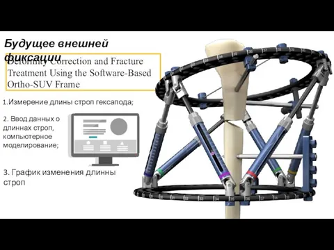 Deformity Correction and Fracture Treatment Using the Software-Based Ortho-SUV Frame Будущее