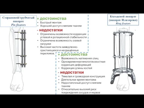 + достоинства Быстрый монтаж Хороший доступ к мягким тканям - недостатки