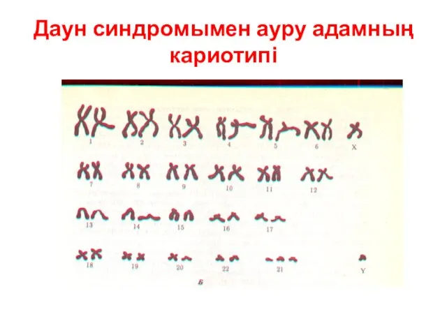 Даун синдромымен ауру адамның кариотипі