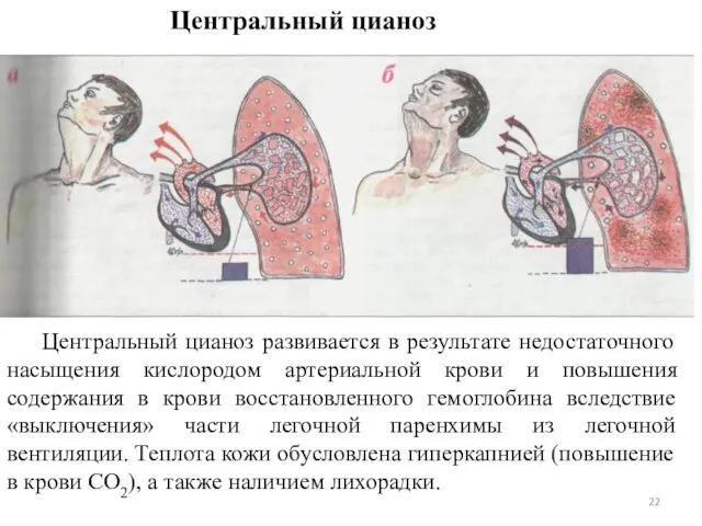 Центральный цианоз развивается в результате недостаточного насыщения кислородом артериальной крови и